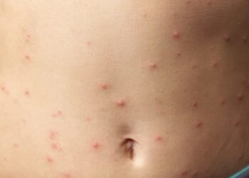 vargem-grande-paulista-convoca-populacao-para-se-vacinar-contra-o-sarampo