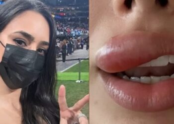 Entenda a condição que causou inchaço na boca de Bruna Biancardi