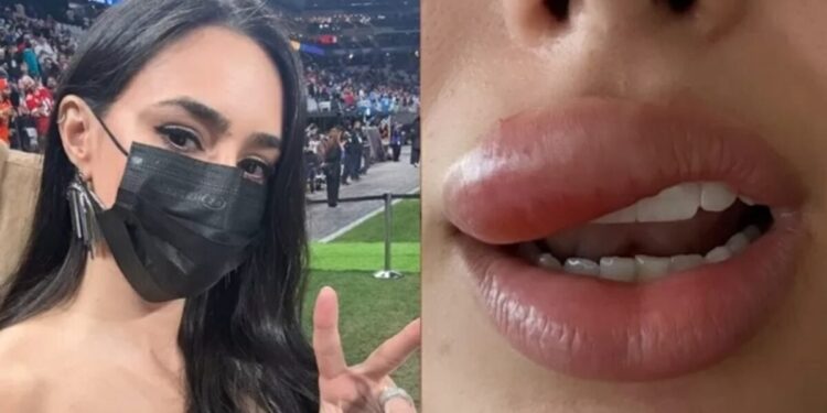 Entenda a condição que causou inchaço na boca de Bruna Biancardi