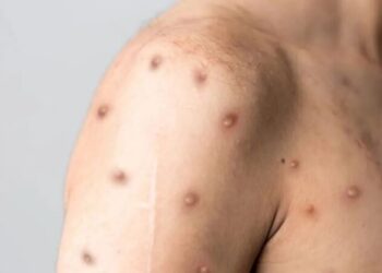 ministerio-da-saude-registra-88-casos-de-mpox-no-brasil-em-2026