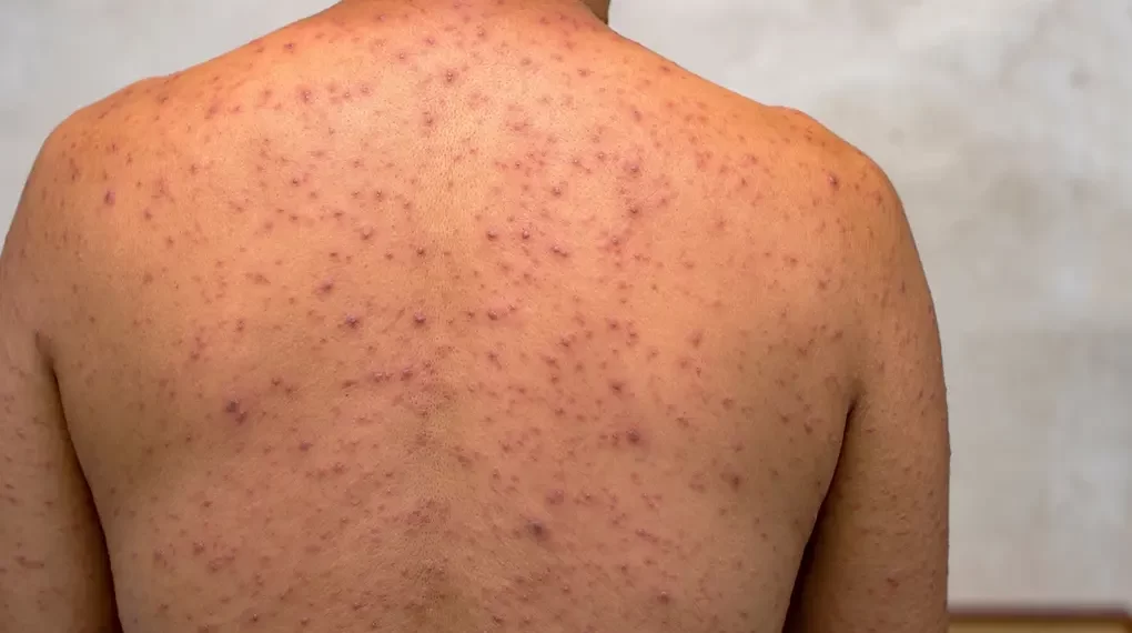 Brasil registra 136 casos de Mpox e cinco novos estados entram no mapa da doença