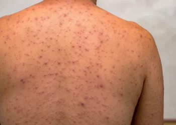 Brasil registra 136 casos de Mpox e cinco novos estados entram no mapa da doença