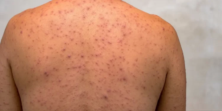 Brasil registra 136 casos de Mpox e cinco novos estados entram no mapa da doença