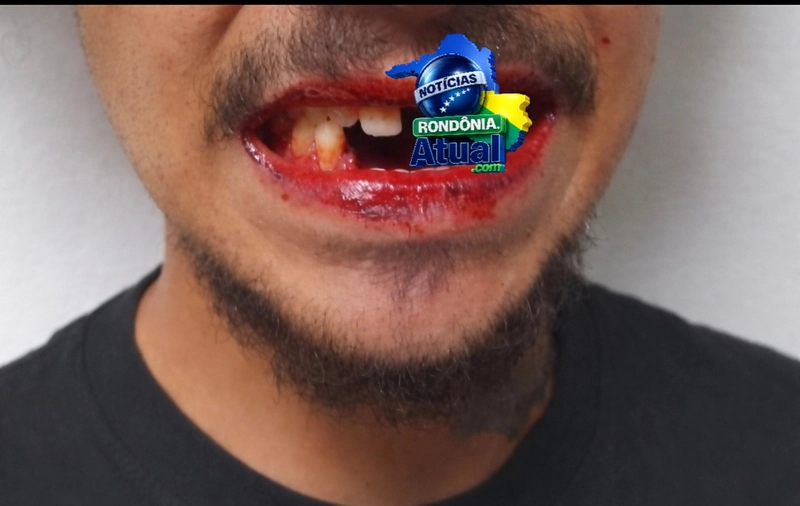 Briga após noitada em Ji-Paraná termina com homem com braço e dentes quebrados na barra de ferro
